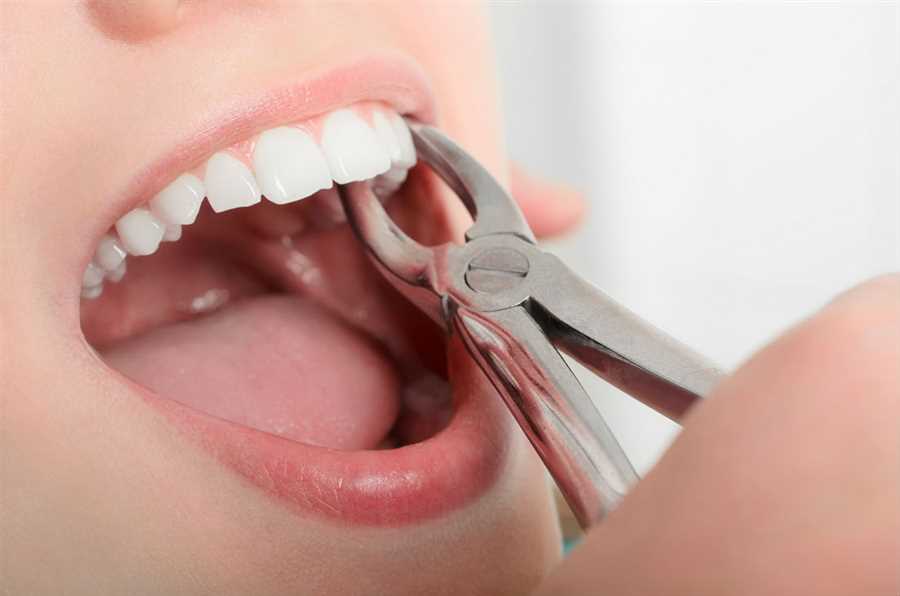 Surgical Tooth Extraction Hawkesbury