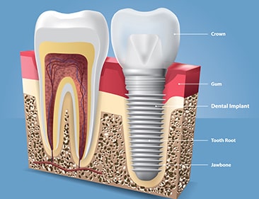 Implants