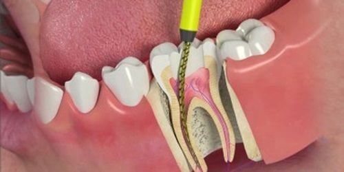 Root Canal Treatment