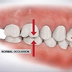 Root Canal Treatment