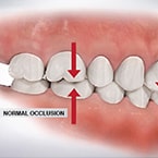 Root Canal Treatment