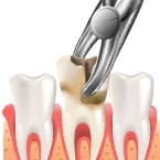 Root Canal Treatment