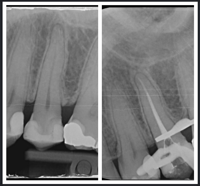 Root Canal Treatment