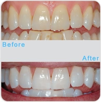 Teeth Whitening